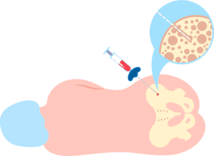 biopsia-medula-ósea